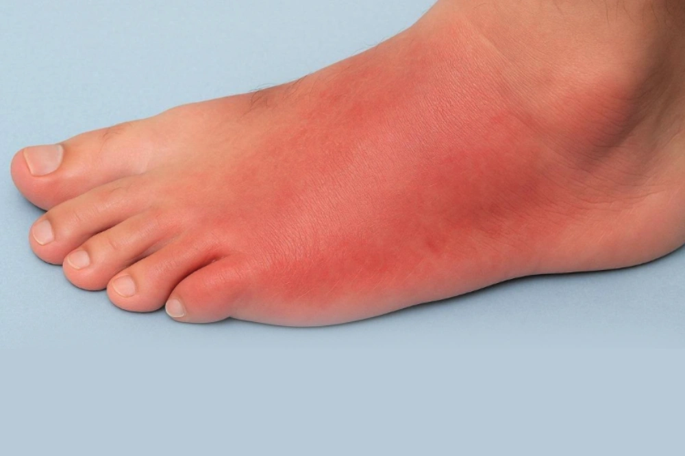 Cellulitis cellulitis main