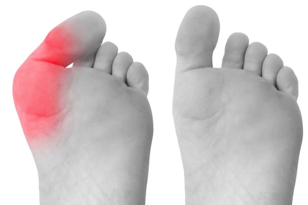 Services Bunion pain highlighted on foot at big toe joint, treated at Valley Foot & Ankle Institute in Manteca, CA