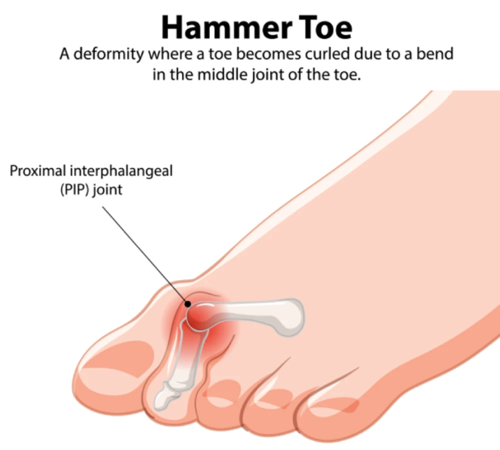 Hammertoes hammertoes asa