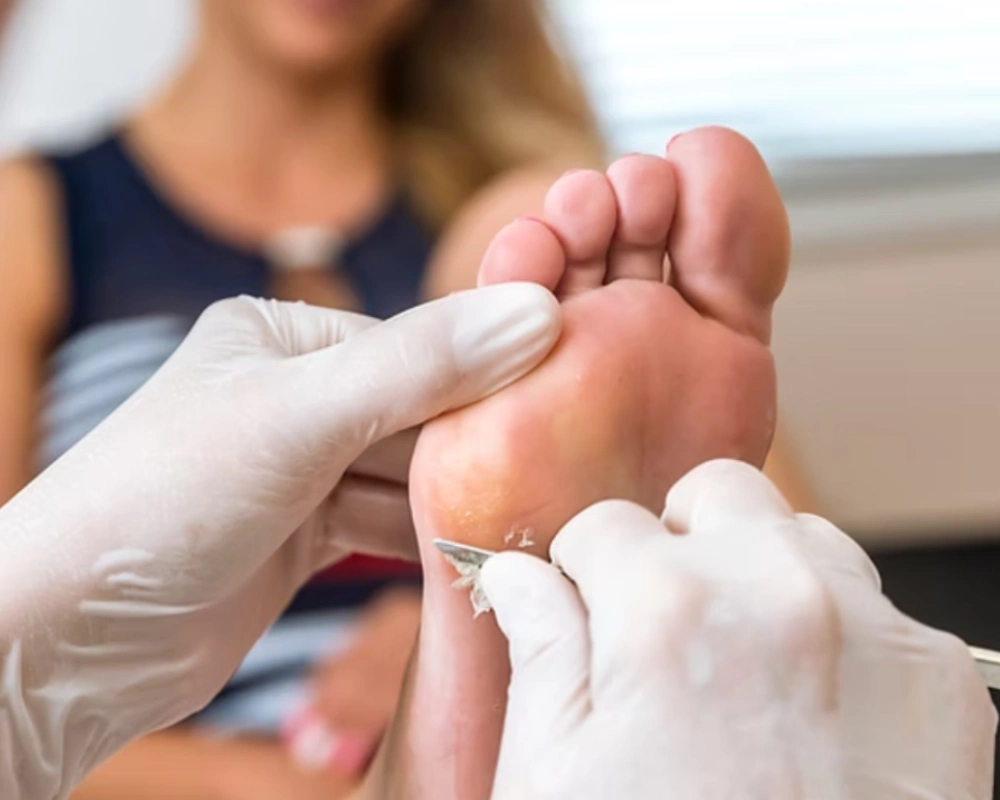 Corns & Calluses surgical treatment bbbh